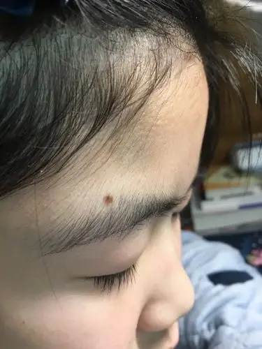 孩子眉毛这颗痣越长越大了 怎么办