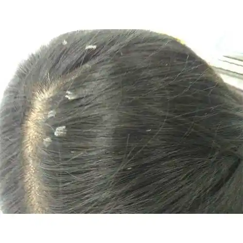 头部毛囊炎用什么洗发水好?中国本土洗发水品牌_头皮