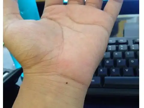 女人手腕有痣的命运怎么样