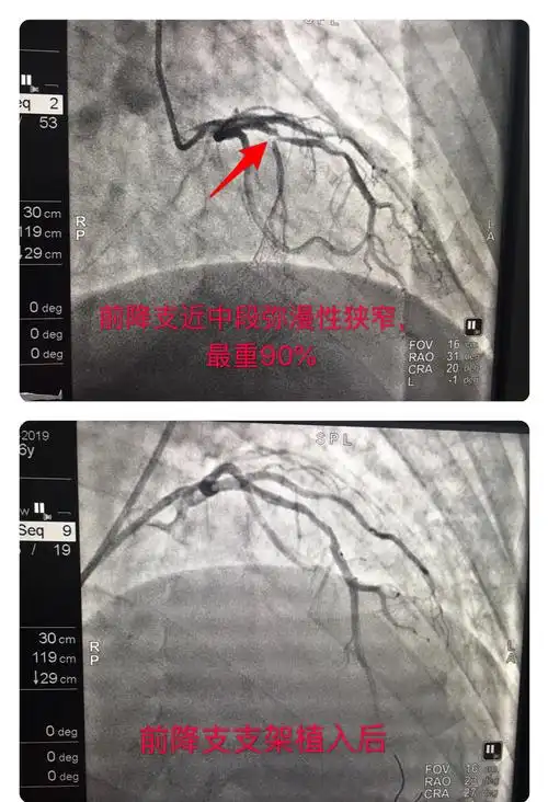 我院今成功完成7例冠状动脉造影术 其中2例植入心脏支架