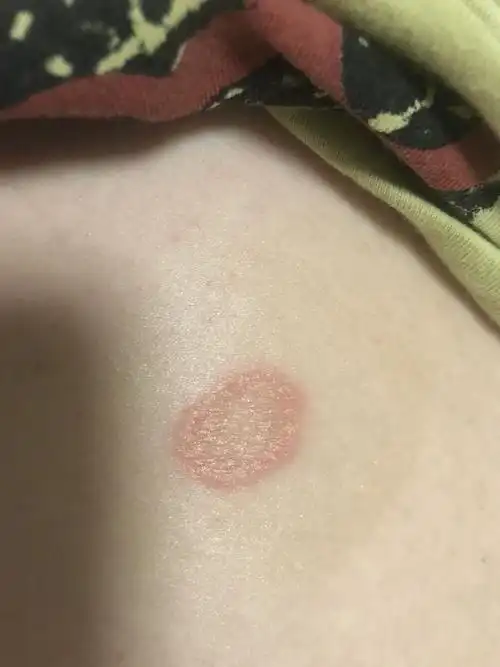 请问这是什么癣?有点痒 没别的感觉