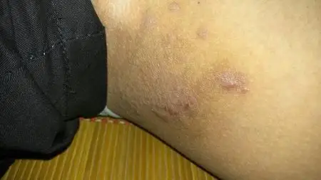 问:大腿两侧直间有这些.会突然很痒.什么来的?