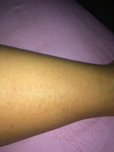 女生大腿侧面长毛怎么回事?怎么去除?很粗,不想用脱毛膏刮掉!