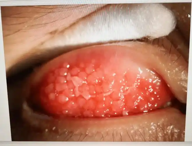 12岁小孩翻开眼皮,竟密密麻麻都是.