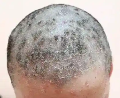 头部脂溢性皮炎