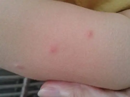 孕妇疥疮初期腹部皮肤症状图片