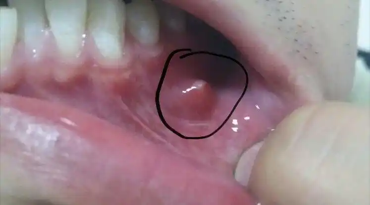 牙龈与嘴唇之间长了个小包块(如图),离现在已经一个礼拜了,不痛,摸