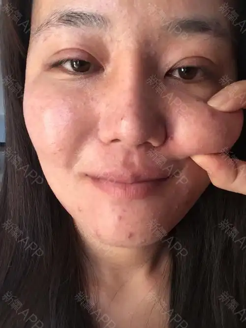 关于脂肪填充失败的在网上看到转载给大家看看-新氧圈子