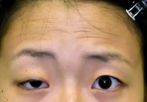 重症眼睑下垂怎么办? - 日志 - 凉拌小鹿子 - 伴我网