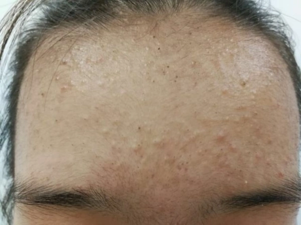 闭口粉刺该怎么祛除