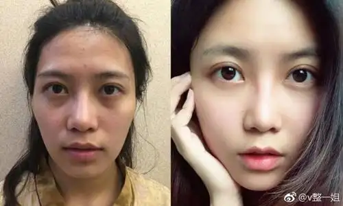 北京自体脂肪填充全脸案例分享,术前术后一个多月前后对比.