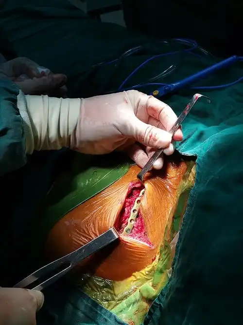 术后复查效果,伤口愈合好.