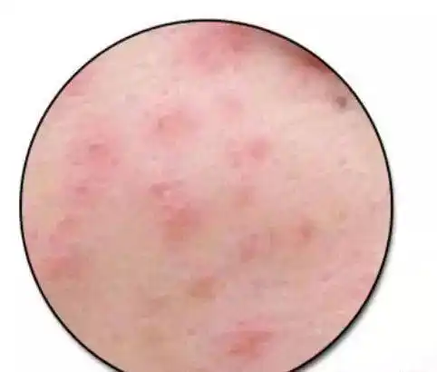 下面痒还长小疙瘩那不是性病而是外阴湿疹