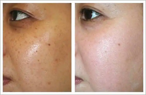 了解肤色暗黄形成的原因,拥有白皙肌肤不是问题_皮肤