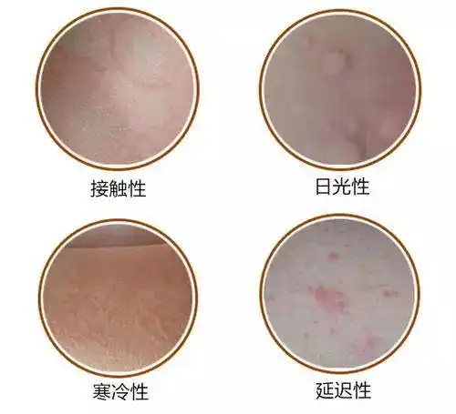 针对湿疹,荨麻疹的复发,如何解决皮肤瘙痒呢?_腾讯新闻