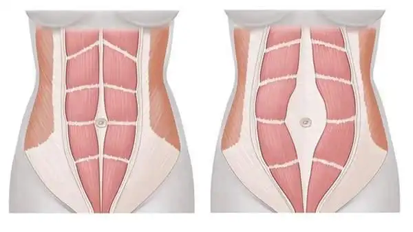 生完后肚子还是大的是什么原因?这才是产后妈妈的真实状态!