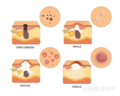 不同类型痤疮的解剖方案. 丘疹的结构