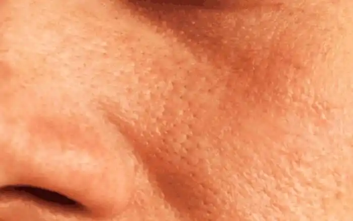 毛孔粗大又老又丑牢记3注意拯救毛孔变细变小