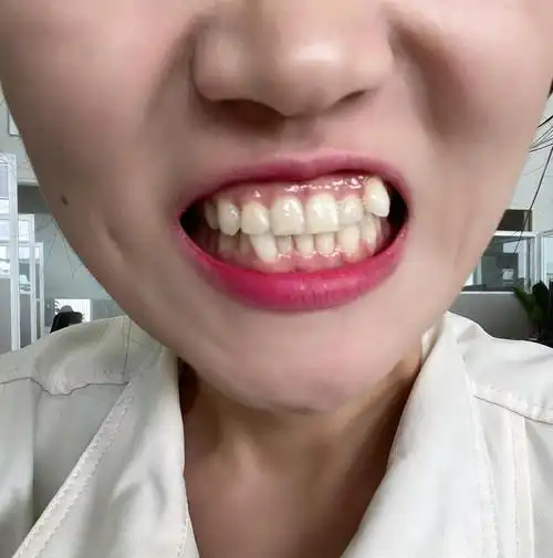 如图,正面我又很深的法令纹, 其实是我两颗虎牙的牙根太大,撑在鼻子