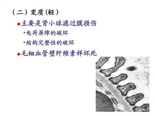 肾炎ppt (二)变质(轻)   主要是肾小球滤过膜损伤  电荷屏障的破坏