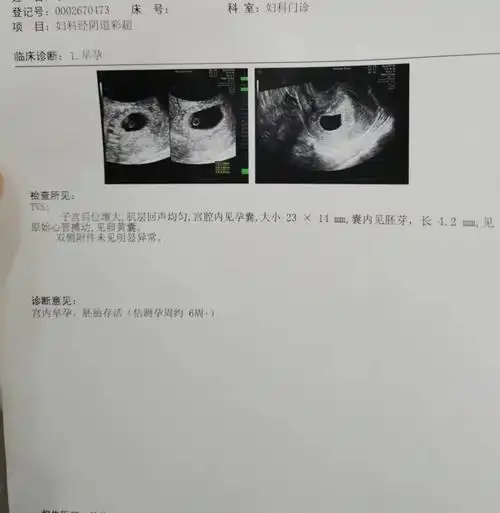 新鲜热乎的胎心胎芽来啦