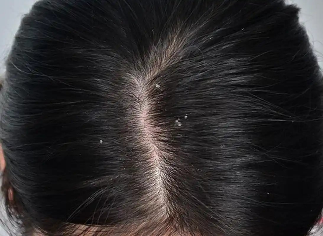 最近发现自己的头发变得越来越油,而且还出现了一些头皮屑.