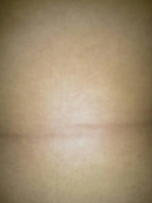 因为肥胖肚子上有好长一条线,怎么去掉啊