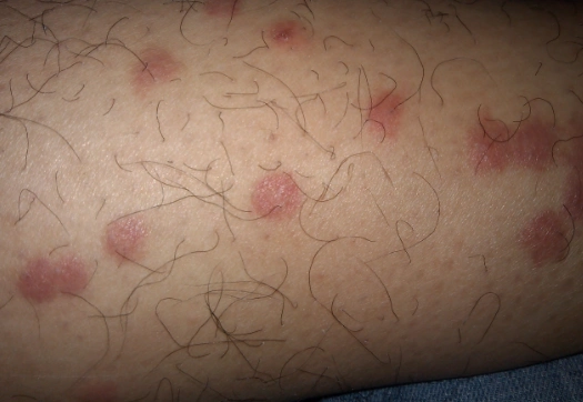 艾滋病早期发病图片 (3)