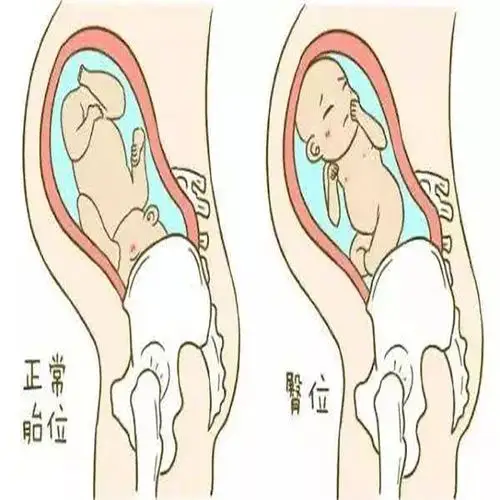 做手术前,医生检查一遍,又发现宝宝现在已经转头位了,正准备入盆,哈哈