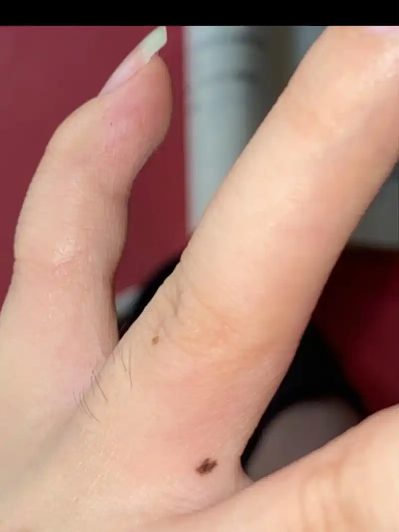 感觉手上的痣在慢慢变大 是错觉吗?