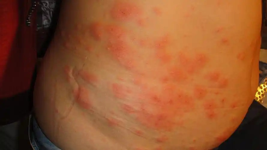 看图诊病-《春季皮肤病病例征集》 - 全科医疗专业讨论版 - 爱爱医医