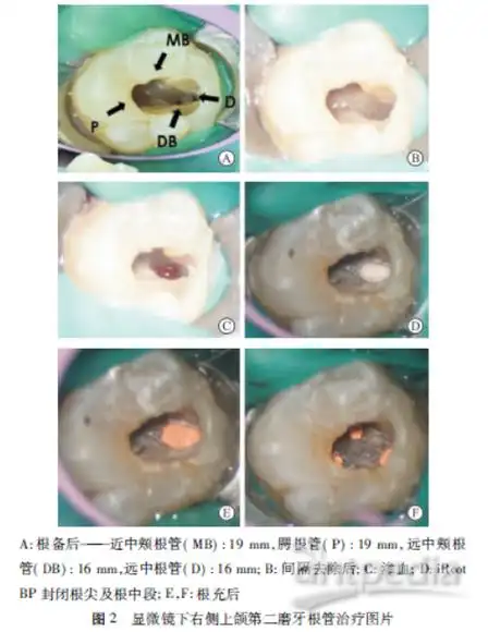 上颌第二磨牙双生牙的根管治疗病例报告1