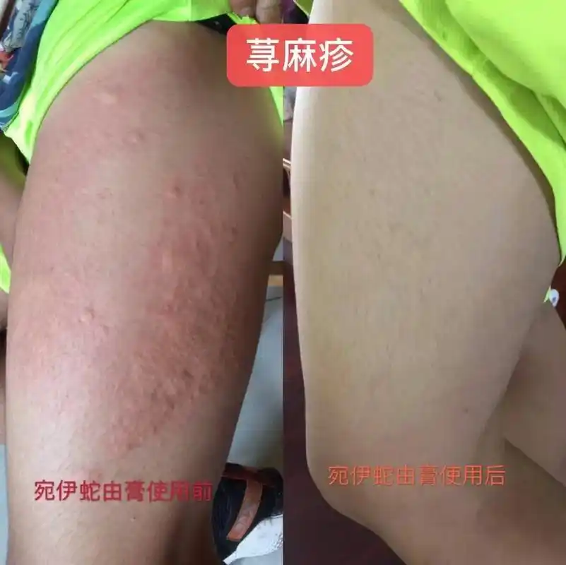 友友们晚上好!有皮肤方面的困扰可以咨询我,湿疹,皮廯,手脚开 - 抖音