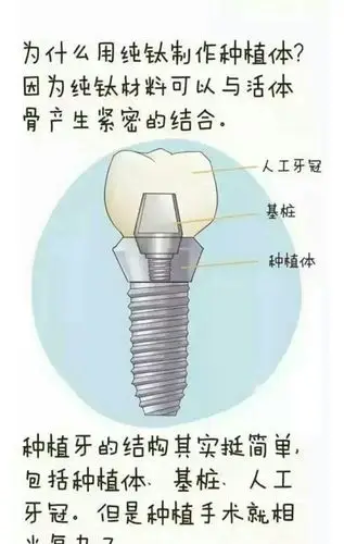 种植牙是如何种的?------介绍种植牙的过程@金陵牙医(20170521小满) -