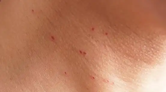 52岁大姐查出宫颈病变半年后离去医生身体异常莫要忽视