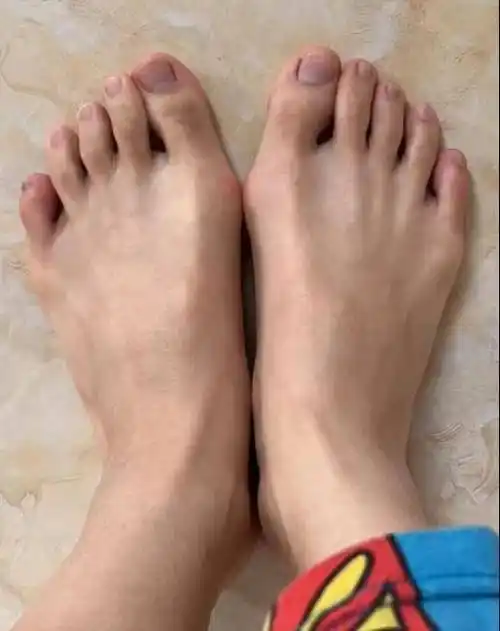 最近两年左脚有点轻微叠趾,怕后面真的叠一起,穿鞋更难受.