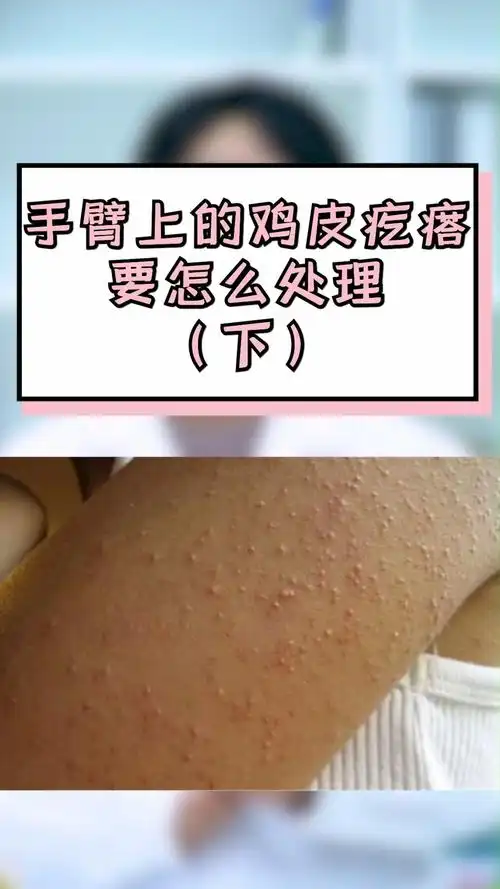 独竖一知好知识手臂上的鸡皮疙瘩要怎么处理