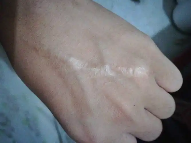 请问手背上差不多有7厘米的伤疤可以去当兵吗?