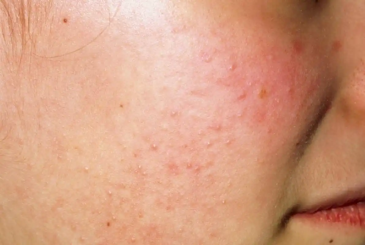 原创皮肤变差的罪因找到了占一半以上的人皮肤毛孔易堵塞