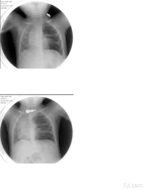 典型的小儿胸片结果已公布