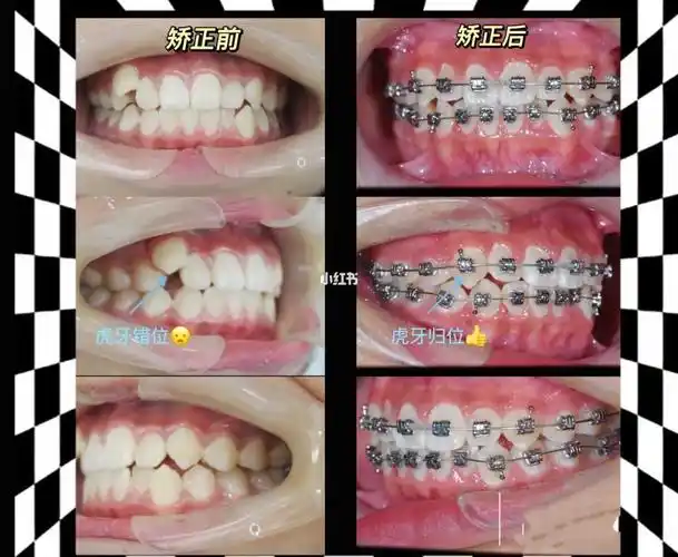 七年级男生牙齿矫正虎牙到合理的位置了_牙套_牙齿矫正_青春期_矫正