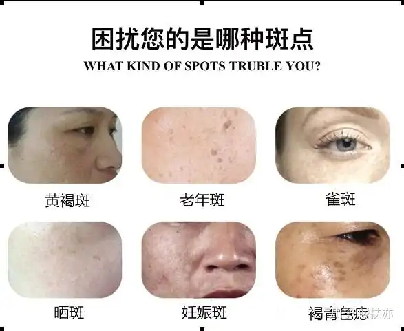 斑点的形成与对应办法