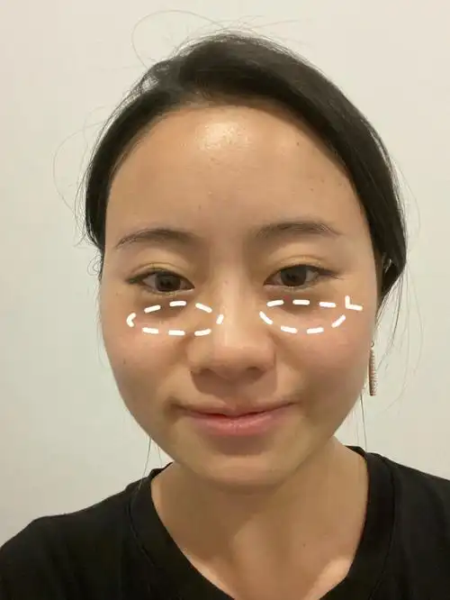 泪沟填充后续来了