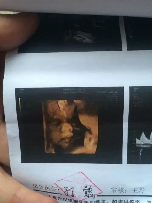 宝宝前两天照的四维,鼻子那块挡住东西了,医生说显像问题,可是谁能