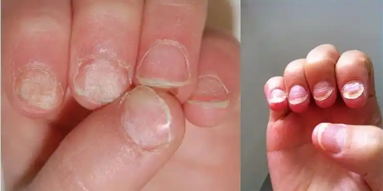 苦甲水会戒掉孩子啃指甲的毛病吗