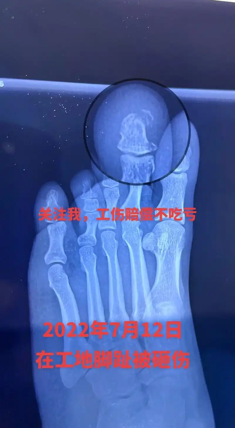 工作中脚趾头受伤能达到伤残吗?工伤脚 - 抖音