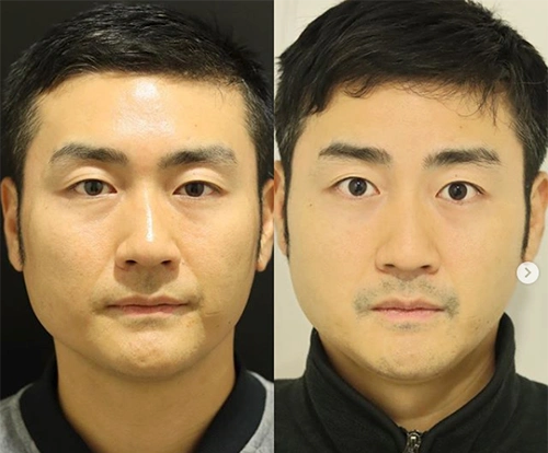 日本isea整形外科男性轮廓手术案例对比