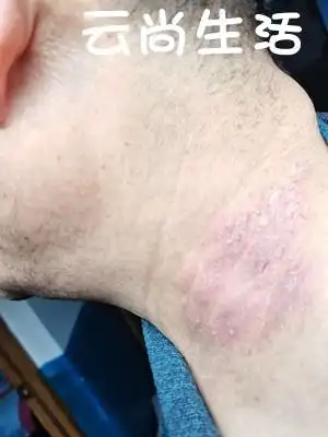 治牛皮鲜藓癣速力安皮大夫 皮肤细胞修复药膏软膏 湿疹