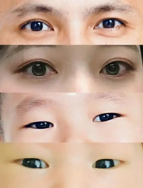 爸爸妈妈都是双眼皮哥哥妹妹都是单眼皮