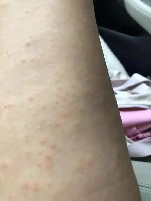 第二天以后皮肤过敏症状日趋严重